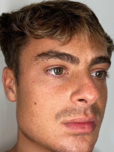 James — after 3 months on VISAGE protocol
